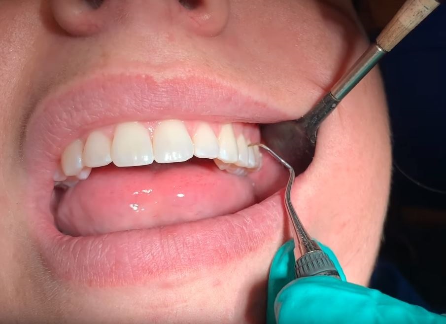 precio limpieza dental en méxico